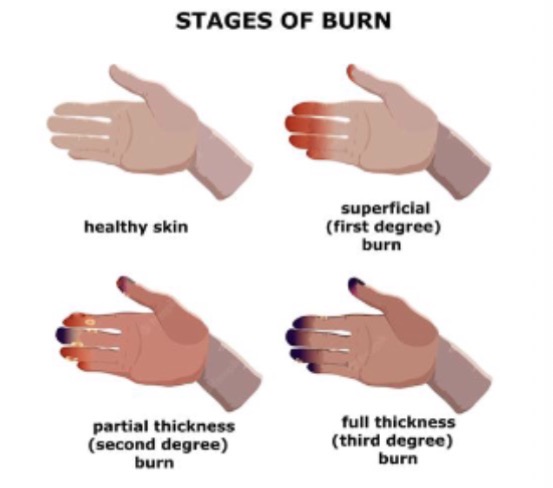 <ul><li><p>1st degree: superficial epidermal, red/swollen/painful</p></li><li><p>Superficial dermal: epidermis + part dermis, pale pink, painful, small blisters</p></li><li><p>2nd degree/partial thickness: epidermis + dermis, red/blotchy, moist/dry, swollen, blistered</p></li><li><p>4th degree/full thickness: all layers destroyed, white/black, leathery/waxy, may be painless</p></li></ul><p></p>
