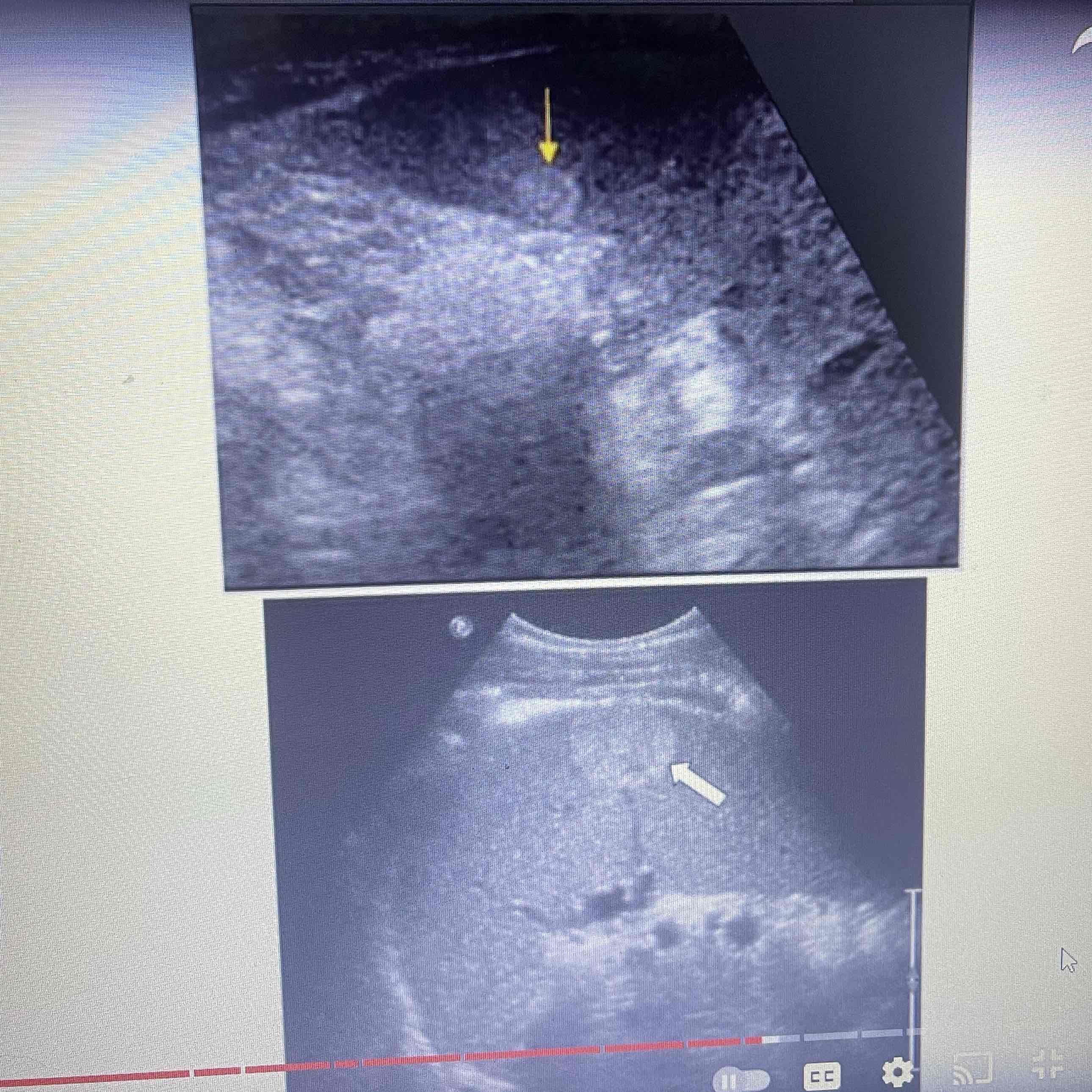 <ul><li><p>Proliferation of vascular channels: cluster of blood vessels</p></li><li><p>MC, benign splenic tumor</p></li><li><p>Clinically: Asymptomatic</p></li><li><p>Sonographic: Isolated, Heterogeneous echogenic mass with multiple hypoechoic areas, Heterogeneity Caused by areas of cystic changes or hemorrhage</p></li></ul>