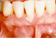 <ul><li><p>with its lower or more apical gingival margin can also result from periodontal disease, tooth position, abrasion by incorrect toothbrushing, and strong frenal attachments, abfraction from occlusal tresses such as parafunctional habits, aging</p></li></ul><p></p>
