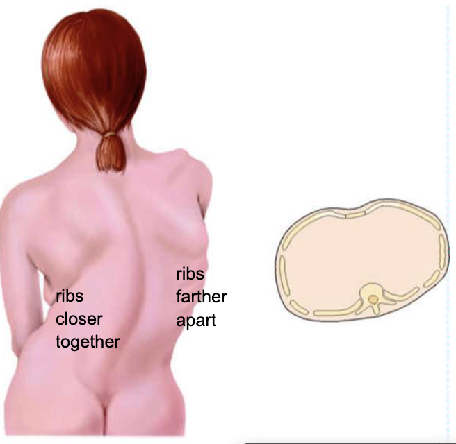 <p>abnormal, ribs closer together on one side and ribs rather apart on other </p>
