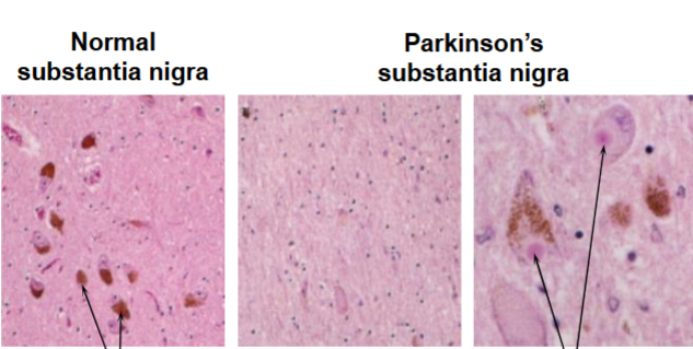 <p>How would you know that the second 2 pictures have Parkinson’s disease</p>