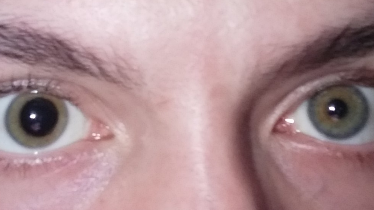 <p>PP: unequal pupils</p><p>E:<br>greater in bright light→large pupil can’t constrict→parasympathetic<br>-blunt trauma<br>-open-angle glaucoma<br>-oculomotor (CN III) paralysis<br>-tonic pupil</p><p>greater in dim light→small pupil can’t dilate→sympathetic<br>-horner syndrome</p>