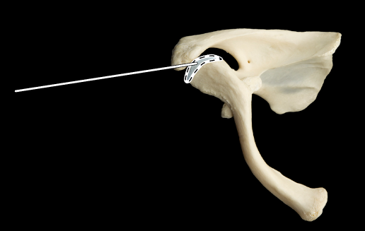 <p>Name the highlighted portion.</p><p>(Superior view, right clavicle and scapula).</p>