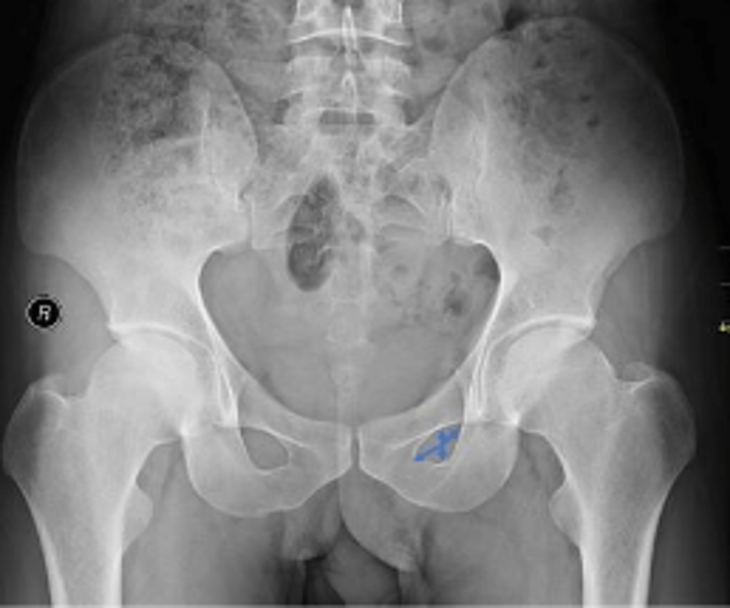 <p>How many degrees of internal rotation of the lower extremities is required for this view?</p>