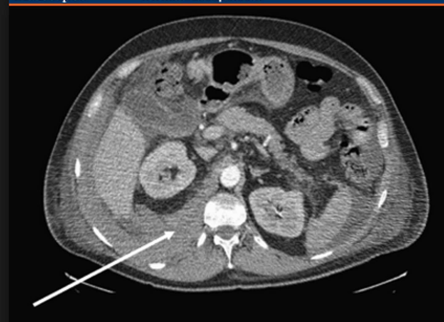 <p>Retroperitoneal hematoma</p>