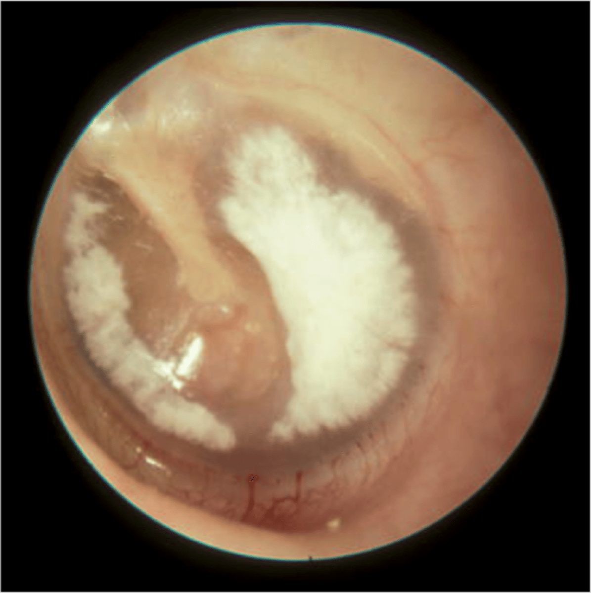 <p>white scarring on TM dt ear infection/ear tubes</p>
