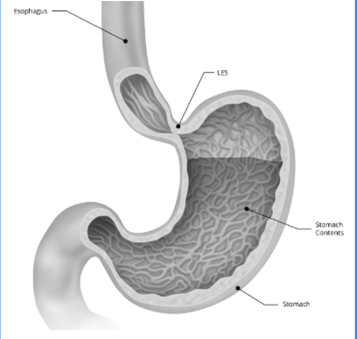 <p><span>The right diaphragmatic crura encircles the LOS at the oesophageal hiatus&nbsp;</span><br><span>It has a pinch-cock action which increases pressure to prevent gastric reflux. It happens during inspiration or abdominal strain&nbsp;</span></p>