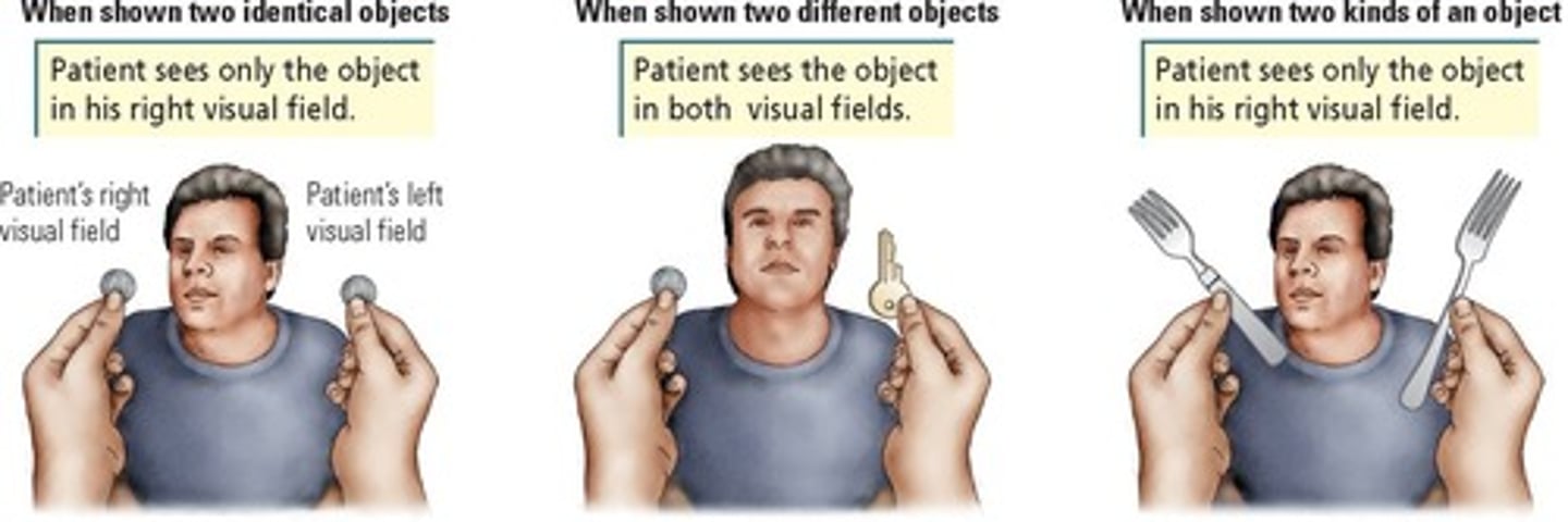 <p>Difficulty in visually-guided reaching movements.</p><p>- bilateral</p><p>-damage in where/how pathway</p>