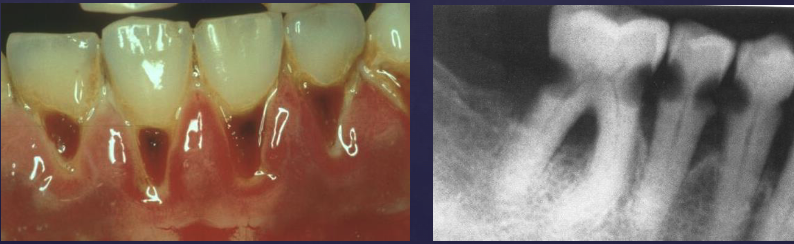 <ul><li><p>xerostomia</p></li><li><p>pH altered → decalcificaition of enamel </p></li><li><p>radiation caries </p></li></ul><p></p>