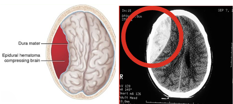 <p>Can result from fracture → rupture/laceration of middle meningeal artery (between dura &amp; skull inferior to thin portion of temporal bone)</p><ul><li><p><strong><u>Clinical Manifestations</u></strong>:</p><ul><li><p>Symptoms progress r/t expanding hematoma.</p></li><li><p><strong>Hallmark: (</strong><span style="color: yellow"><strong>lucid interval</strong></span><strong>)—</strong>Brief loss of consciousness then awake &amp; aware; Later restless, agitated, confused → coma</p><ul><li><p>Lucidity d/t rapid absorption of CSF to compensate</p></li></ul></li><li><p><strong>Herniation</strong>: dilation and fixation of pupils or paralysis of extremity</p></li><li><p>Significant neurological deficits &amp; respiratory arrest within minutes</p></li><li><p><span style="color: red"><strong>MEDICAL EMERGENCY</strong></span></p></li></ul></li><li><p><strong><u>Management</u></strong>:</p><ul><li><p><strong>Burr holes</strong>—openings through the skull to decrease ICP</p></li><li><p>Craniotomy—to remove clot and control bleeding (make room for the brain to swell)</p></li><li><p><strong>Drain placement</strong>—to prevent blood accumulation (EVD)</p></li></ul></li></ul><p></p>