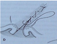Lembert pattern
