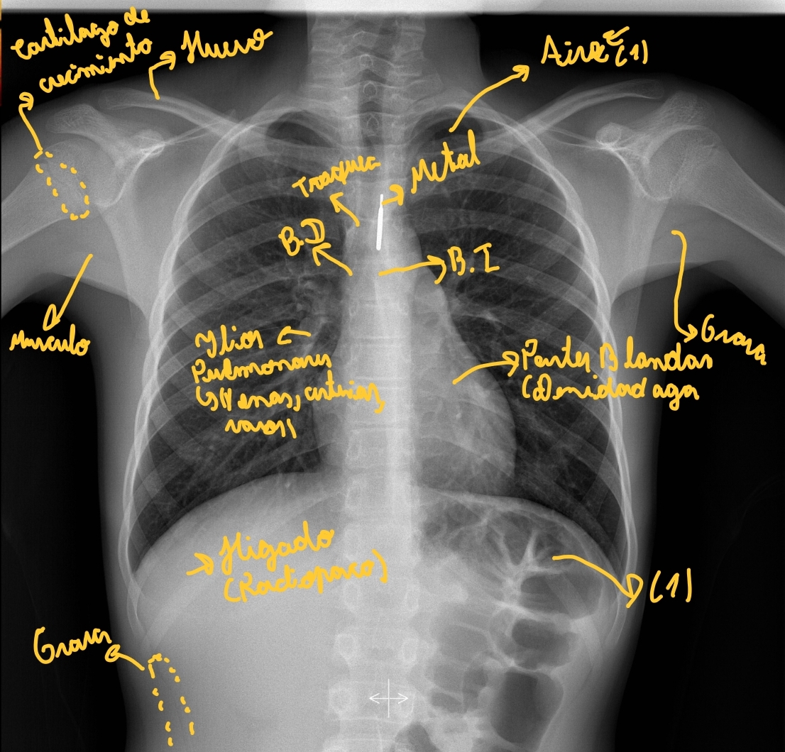 <ul><li><p>La placa es del mismo tamaño, pero se ve más ya que es un cuerpo pequeño, posiblemente un niño por el cartílago de crecimiento</p></li></ul><p></p>