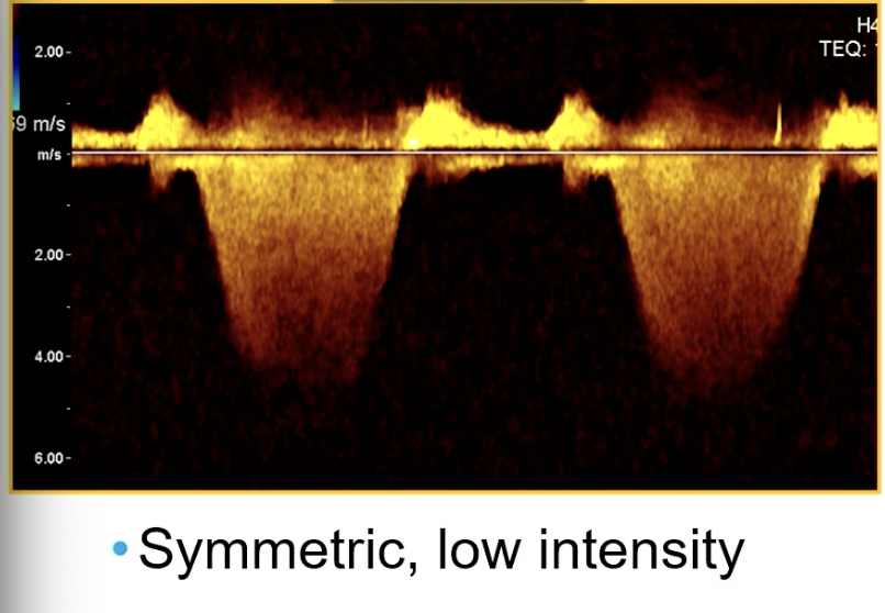 <p>CW through mitral valve</p>
