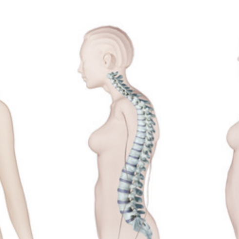 <p>(Hump back) </p><p>Exaggeration of thoracic curve</p><ul><li><p>caused by rickets and poor posture</p></li></ul>
