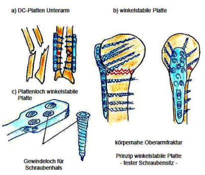 <p>Operative Frakturbehandlung</p><p><strong>Plattensysteme</strong></p><p></p>