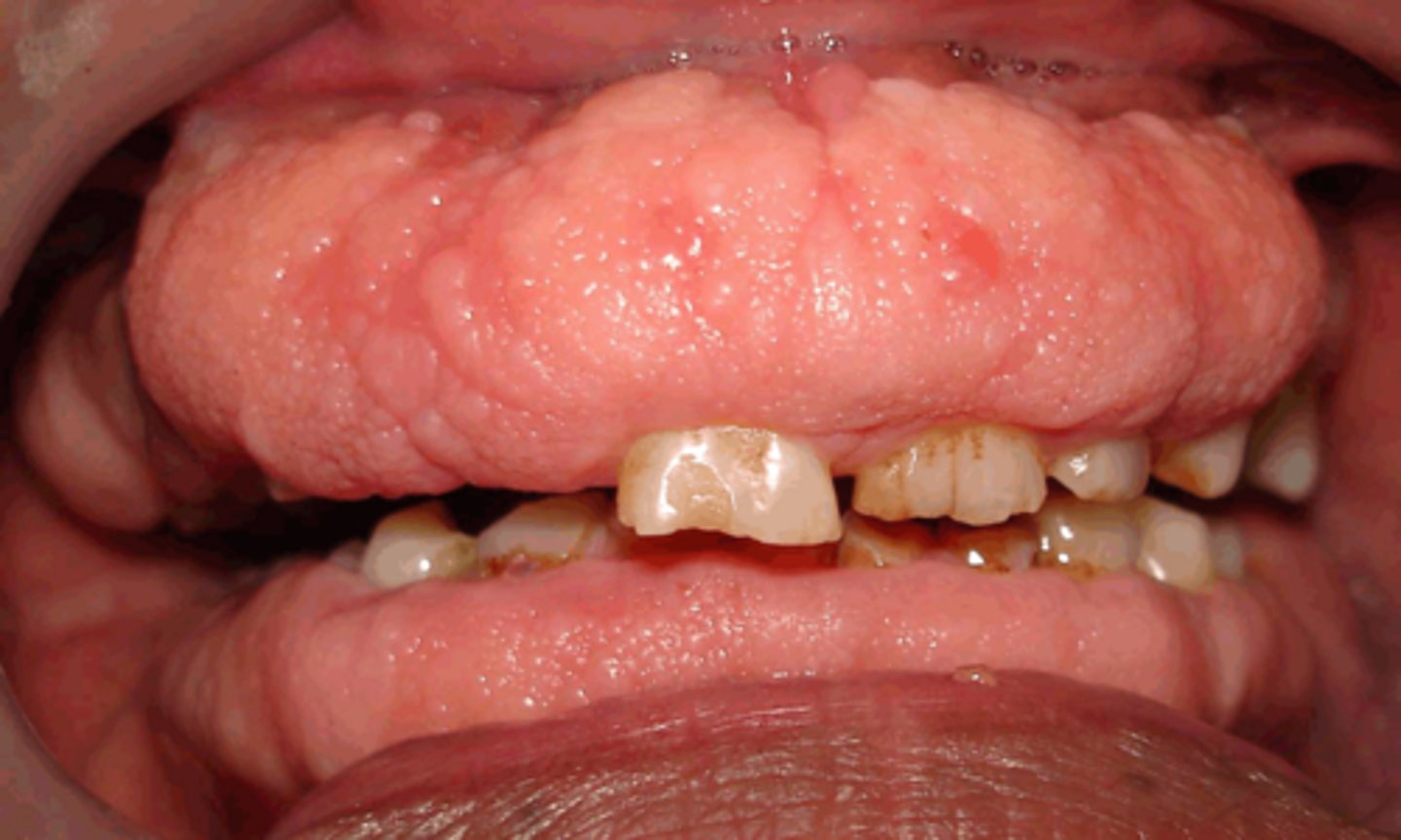 <p>gingival fibromatosis</p>