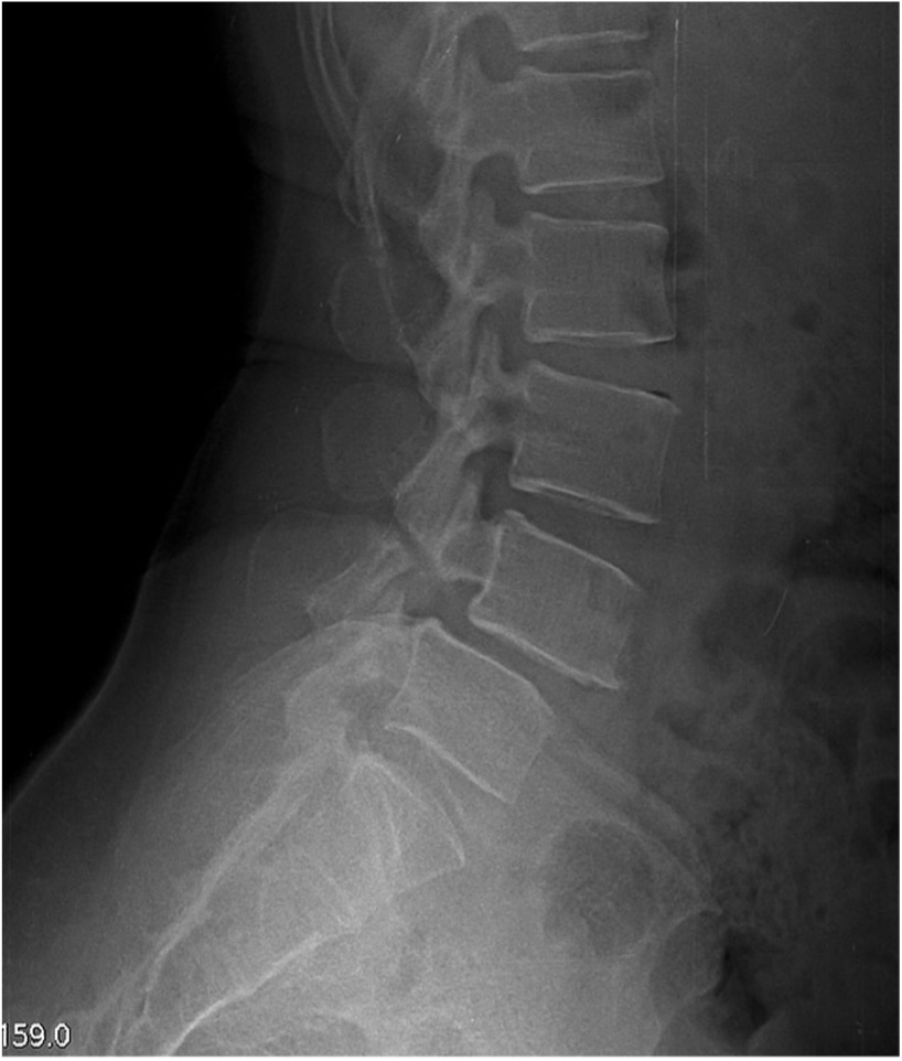 <p><span>A 17 year old elite gymnast presents to her GP with a 5-month history of lower back pain, which increases in intensity upon hyperextension. </span></p><p><span>Lateral lumbar-spine x-ray reveals translation of a vertebral body due to a bilateral pars interarticularis fracture. </span></p><p><span>Which vertebral body and which columns are abnormal?</span></p>
