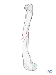 <ul><li><p>broken bone where the break appears at an angle or slant </p></li><li><p>fracture line runs diagonally across the bone </p></li></ul><p></p>