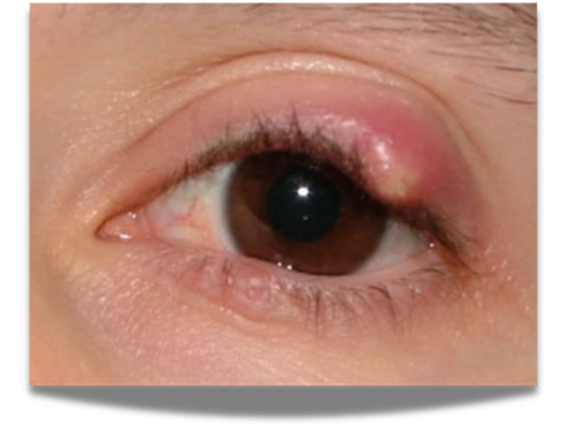 <p>blockage of meibomian sebaceous gland in eyelid; painful</p>