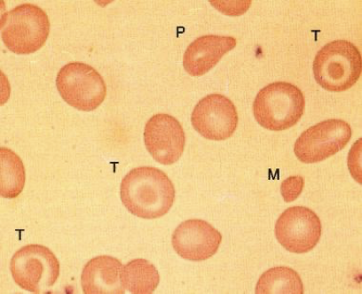 <p>What does this refer to</p><ul><li><p>Peripheral smear in beta-zero thalassemia minor</p><ul><li><p>Microcytes (M)</p></li><li><p>Target cells (T)</p></li><li><p>Poikilocytes (P)</p></li></ul></li></ul><p></p>