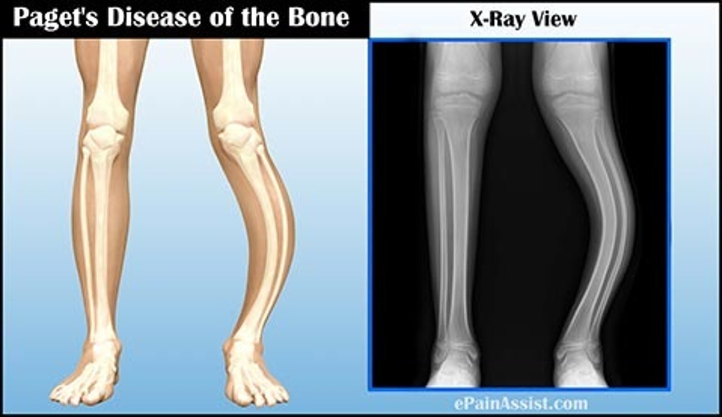 <p>Heightened osteoclast activity, causing excess bone formation that lacks true structural integrity. Bone is large but lacks strength.</p><p>Sxs: MSK pain, bony deformities at skull, clavicle, pelvis, femur, spine, and tibia. Progresses to HA, vertigo, hearing loss, mental deterioration, fatigue, increased CO and heart failure</p><p>Tx: Biphosphonates to limit bone resorption and improve quality of involved bone.</p>