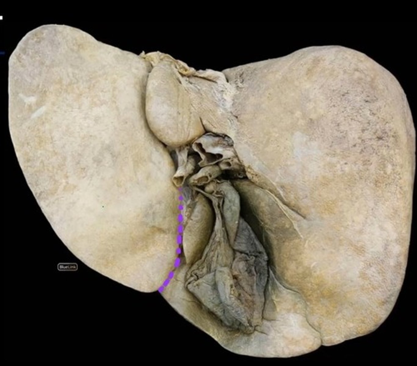 <p>Depression</p><p>- Bottom left side of H</p>