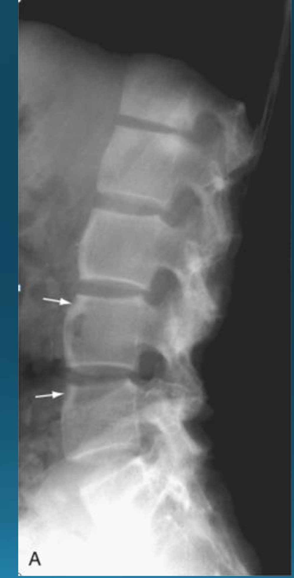 <p>what are the signs seen in this image? what diagnosis would you make? </p>