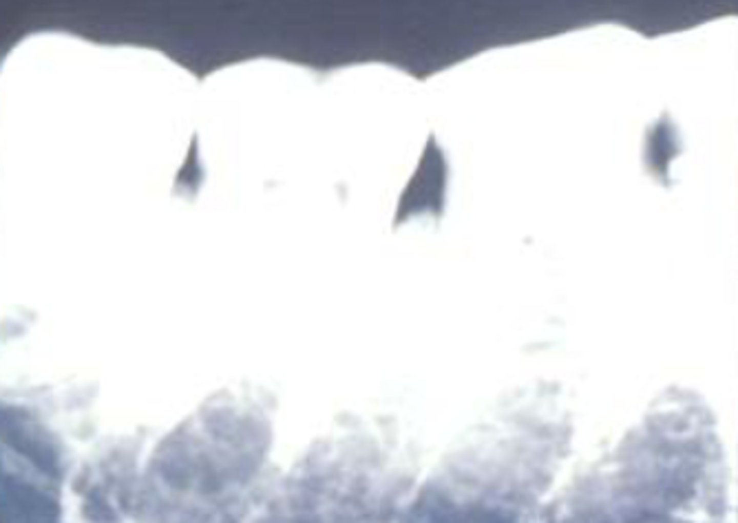 <p>- Fixer time or temperature too high</p><p>- Radiograph light</p>