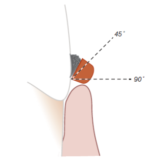 <p>cutting edge will slide over surface of deposit</p>