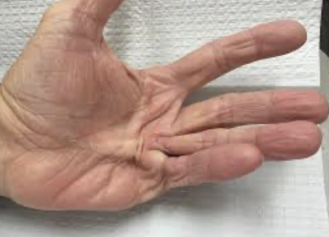 <p>excessively flexed, inability to passively or actively extend the MCP and PIP joints of the involved fingers </p>
