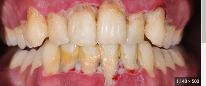 <p><span style="font-family: Droid Sans Mono, monospace">PERIODONTAL DISEASE</span></p>