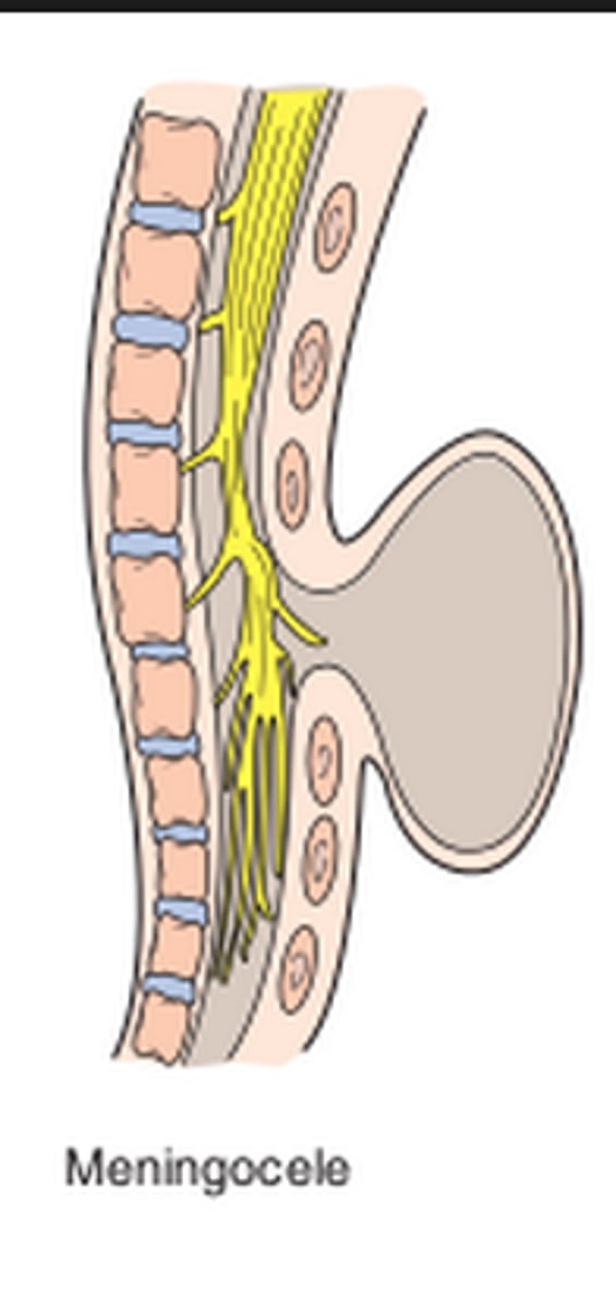 <p>meninges herniate but cord intact</p>