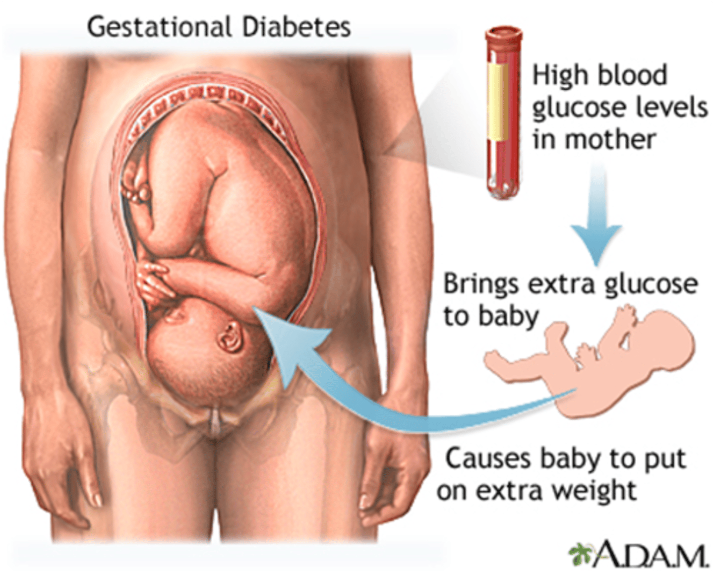 <p>- DM during pregnancy => aka 'Gestational DM' (GDM)</p><p>- Pregnancy hormones cause Insulin resistance, including: Estrogen, Human Placental Lactogen, & Cortisol</p><p>- glucose challenge test to dx @ approx. 24 weeks (once placenta matures)</p><p>- routine screening: Glucose challenge & fasting Glucose BW</p>