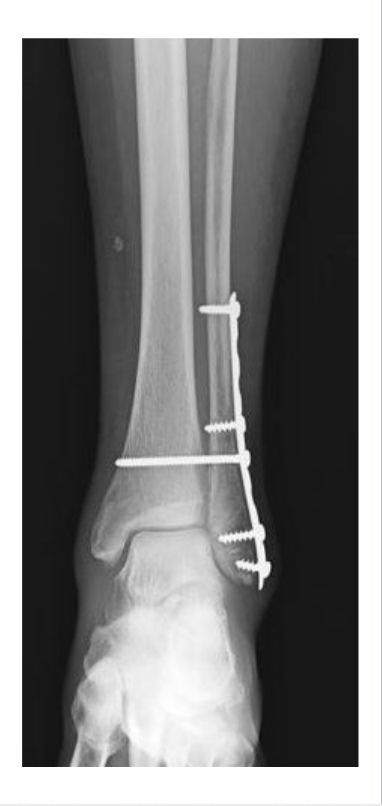 <p>Adequate <strong>blood supply &amp; stabilization</strong> are critical</p><p><strong>Age, nutrition, and hormones</strong> affect repair rate</p><p>Possible complications</p><ul><li><p>Malunion / nonunion</p></li><li><p>Infection (especially open fractures)</p></li><li><p>Epiphyseal damage in children</p></li></ul><p></p>