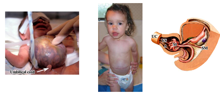 <p>-baby is born with an omphalocele</p><p>-intestines are covered with a layer of parietal peritoneum</p><p>-occurs in 1 out of 5000 births</p><p>-following surgical repair, children do not have an umbilicus, but one can be made by a plastic surgeon</p>