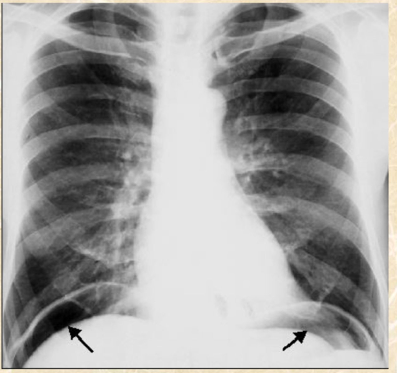 <p>What does this CXR show?</p>