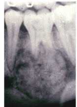 <p>Radiopaque Lesion attached to Tooth Root with a Radiolucent Margin</p>