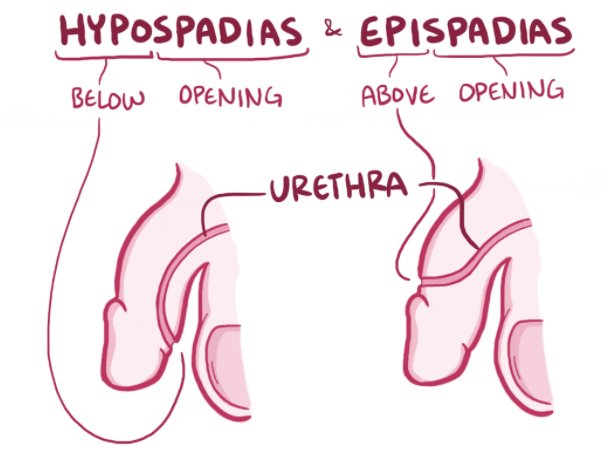 
1. hypospadias and epispadias:
   * hypo → abnormal opening of the urethral meatus on the ventral surface of the penis → more common
   * epi → abnormal opening on the dorsal surface
   * both may be associated with failure of normal descent of the testes with malformations of the urinary tract
   * the abnormal opening is often constricted → urinary tract obstruction → ascending infections
   * when the orifices (openings) are near the base of the penis, normal ejaculation and insemination are hampered → sterility
2. phimosis:
   * = when the orifice of the prepuce (foreskin) is too small to permit retraction
   * usually due to repeated infections that cause scarring of the preputial ring (the very top of the foreskin surrounding the urethral meatus)
   * interferes with cleanliness and permits the accumulation of secretions and detritus → secondary infections → risk of ==__penile carcinoma__==