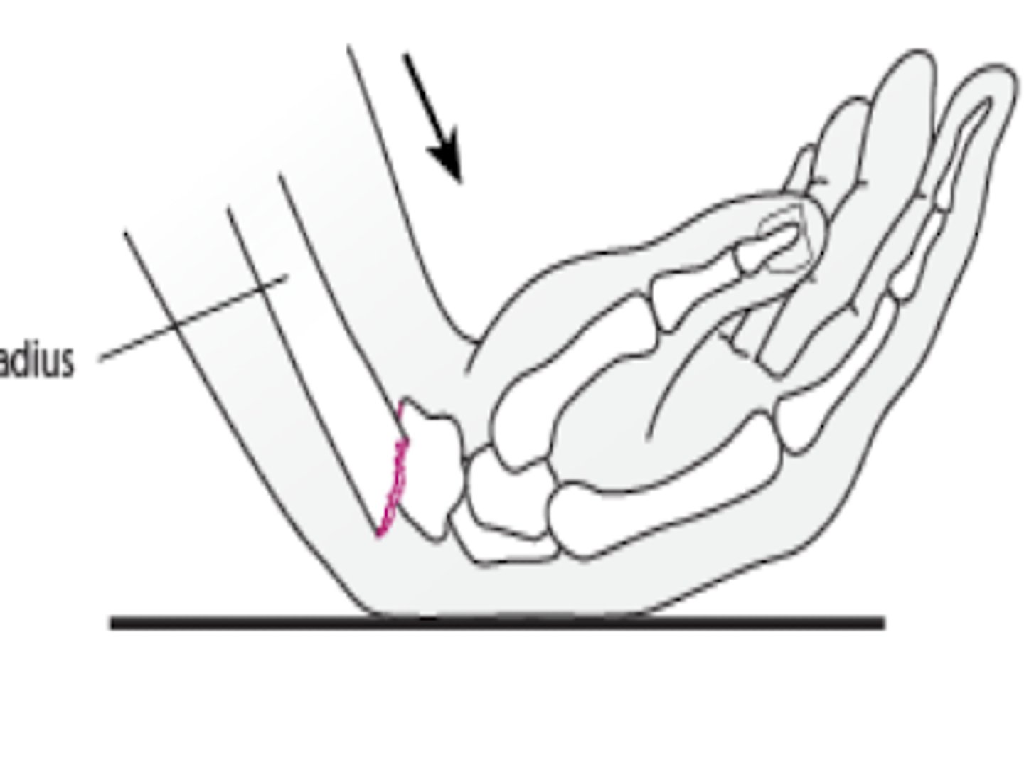 <p>volar displacement of radius </p>
