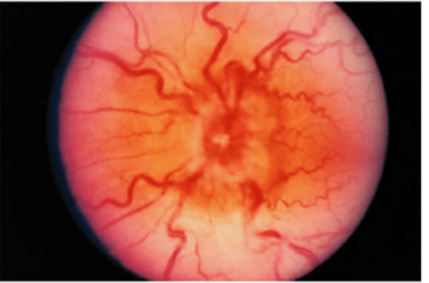 <p>Diagnosis is made with the swinging flashlight test, fundoscopic exam (showing optic disc swelling or blurred disk), and an MRI with gadolinium contrast to work up MS.</p>