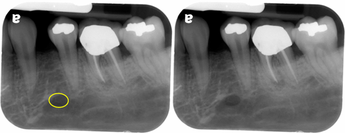 <p>Foramen: Short round or oval tube-like opening through a bone that allows the passage of nerves and blood vessels </p>