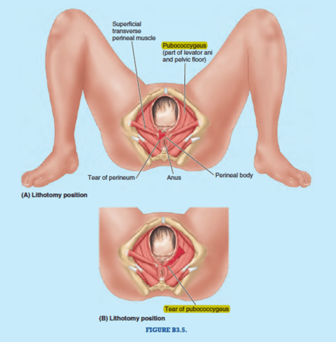 <p>common consequence of vaginal delivery</p><p>- puborectalis and pubococcygeus are most common muscles damaged</p><p>- causes incontinence and sexual dysfunction</p><p>compared to cesarean section</p><p>- vaginal devilry is associated with 2 fold increase risk of pelvic floor dysfunction</p><p>- combo of aging and birth</p>