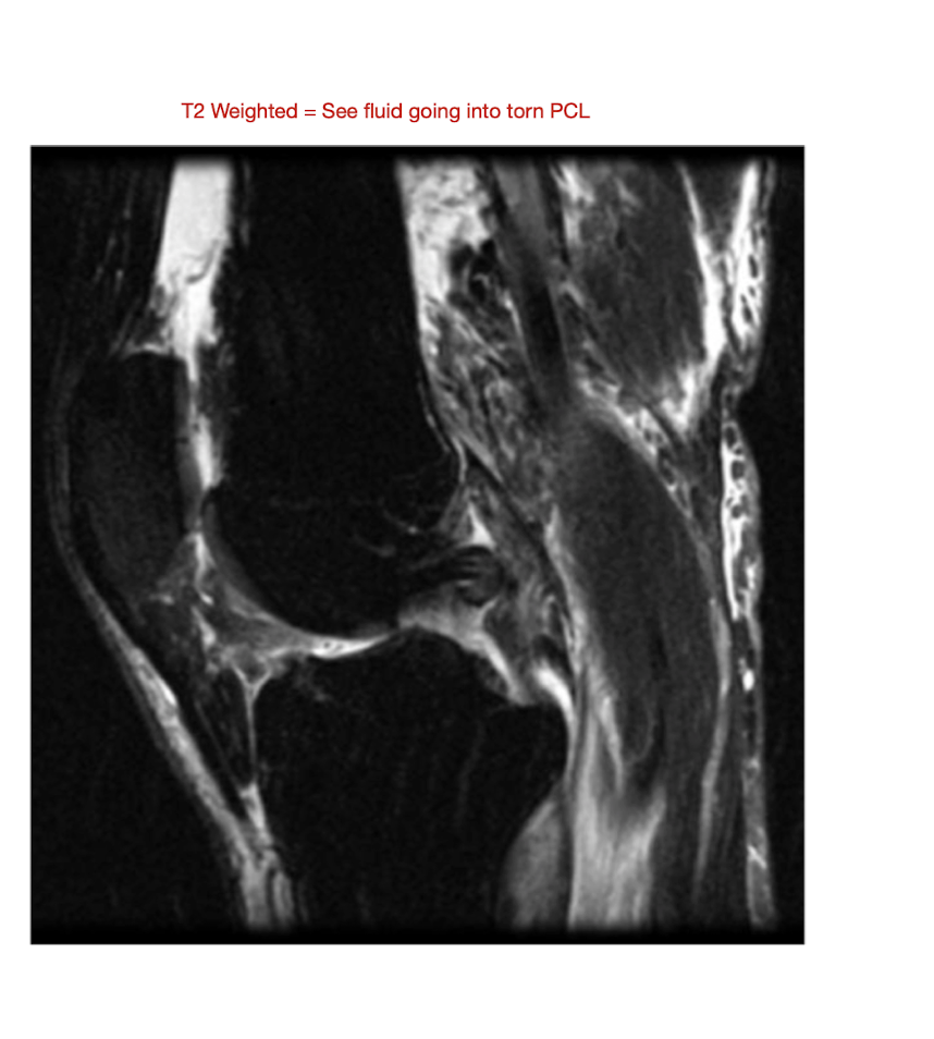 <ul><li><p>Car Accident (Dashboard Injury)</p></li><li><p>Fall</p></li><li><p>Blow at Ant Knee</p></li></ul><p></p>