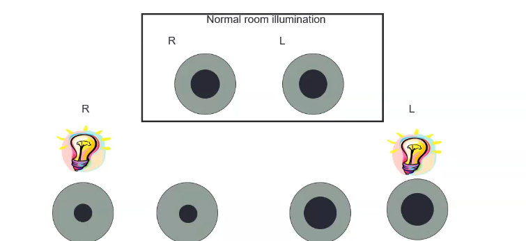 <p>afferent pupil defects: absolute&nbsp;</p>