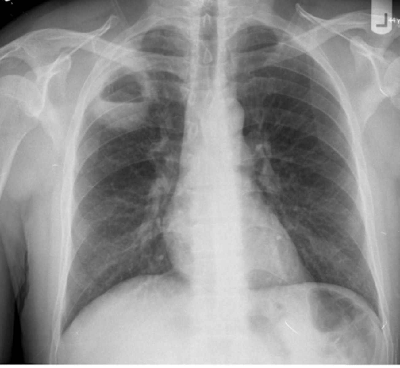 <p>An 80-year-old immunocompromised patient presents with a 2-month history of fever, cough, shortness of breath, fatigue, and unintentional weight loss. Chest imaging shows:</p>