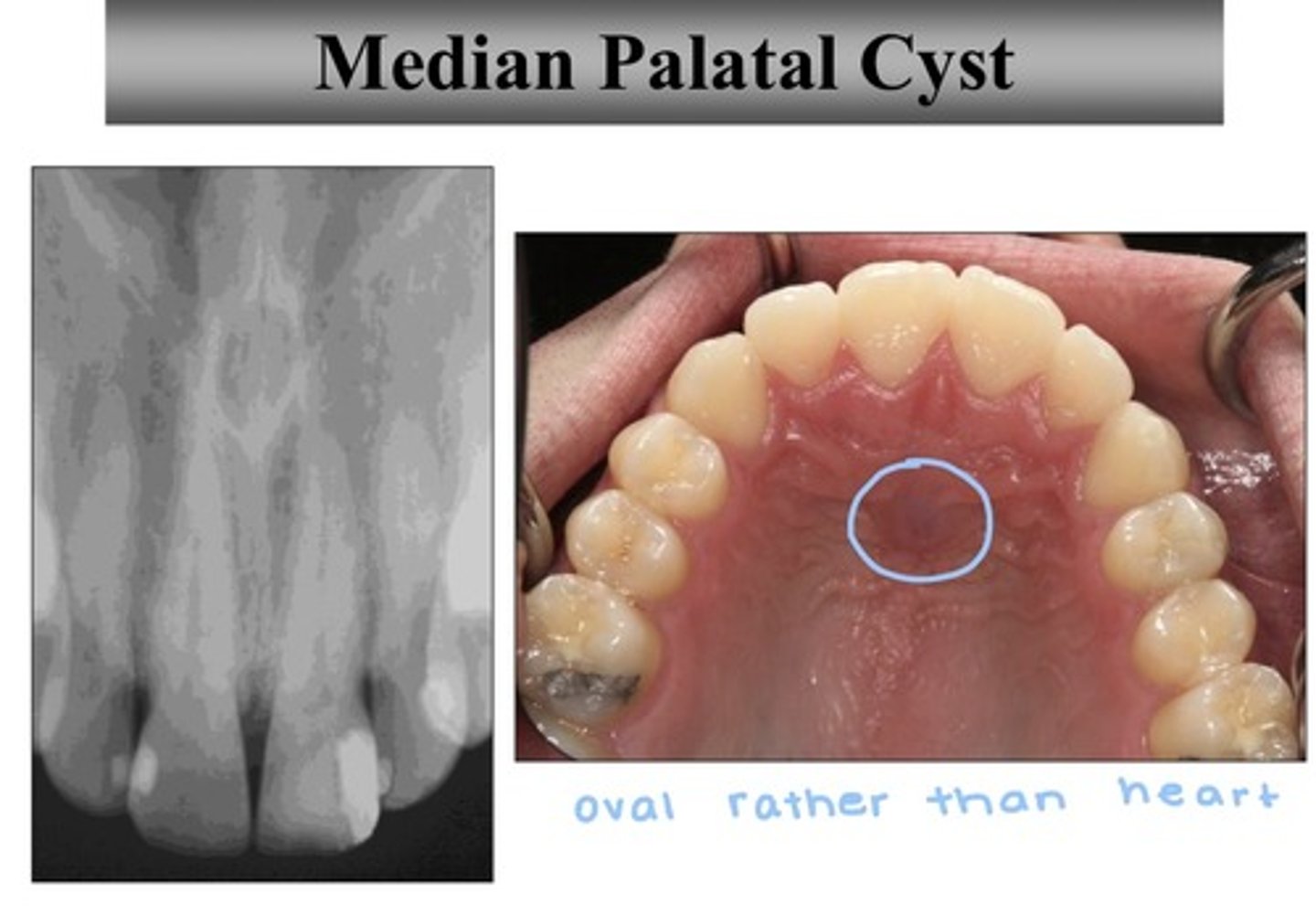 <p>- cause: arises from epithelial remains</p><p>- population: any</p>