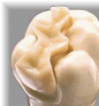 <p>type of indirect restoration used in similar situations as fillings. Pre-made piece of solid material that is bonded into the teeth</p>