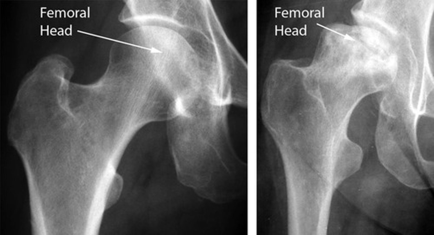 <p>bone death due to lack of blood supply, often in proximal and distal femoral head, X-Ray is most used and MRI is most sensitive modality</p><p>caused by trauma, long term alcohol use, long term glucocorticoid use, sickle cell anemia, pediatric disorders</p><p>findings: devascularized bone becomes denser and more sclerotic</p>