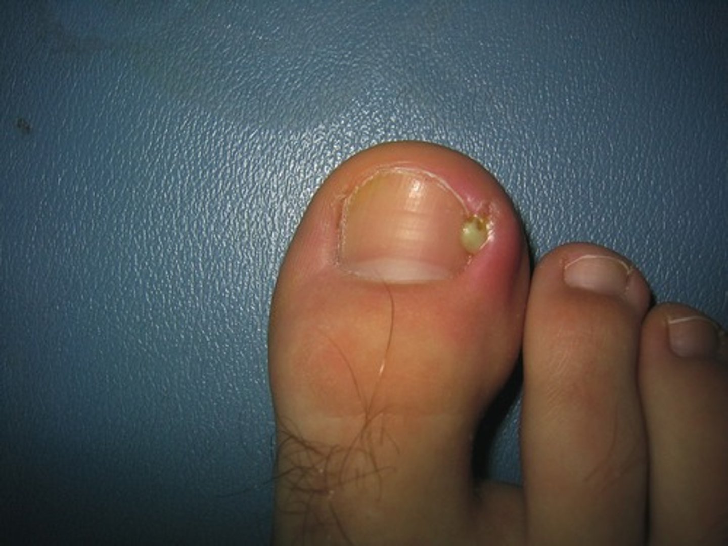 <p>Most Medieval surgeons believed pus meant the wound was healing. They were wrong, as it is a sign of infection.</p>