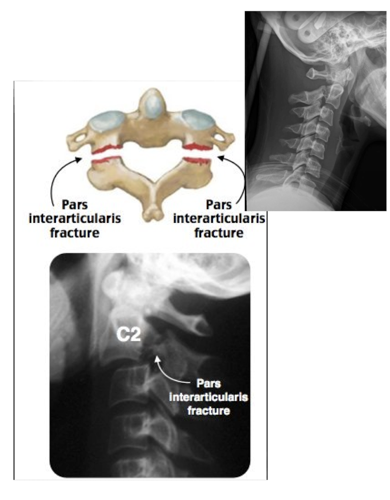 <ul><li><p>Bilateral Fx of the pedicles of C2 w dislocation of vertebral body C2 on C3</p></li></ul><p></p>